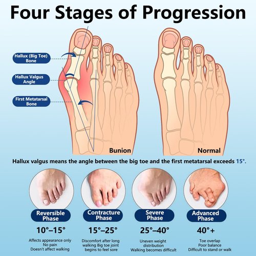 Deedlite Recovist Bunion Brace for Women & Men, Bunion Corrector Big Toe Straightener, Reduce Pain Correct Toe Alignment for Left & Right Foot (A, Black, 1 Pair)