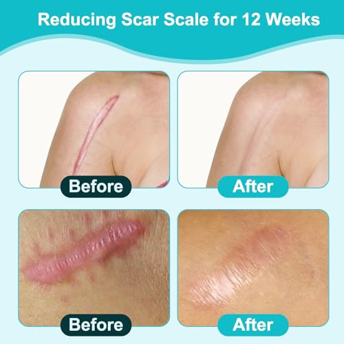 Hydrocolloid Bandage Roll 1.9" x 118" Waterproof Self-Adhesive Wound Dressing