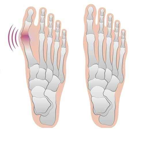 4 Bunion Relief Pads and Sleeves, Orthopedic Bunion Corrector Socks with Gel Pads, 2 Pairs