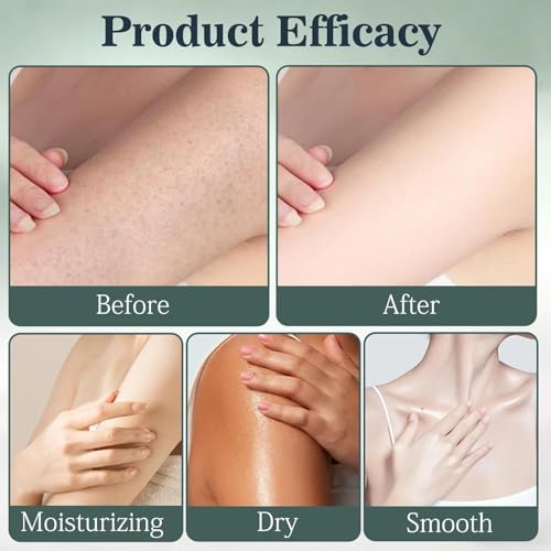 Water Ice Levin Intertrigo Stick & Cream for Skin Fold Care, Chafing Relief