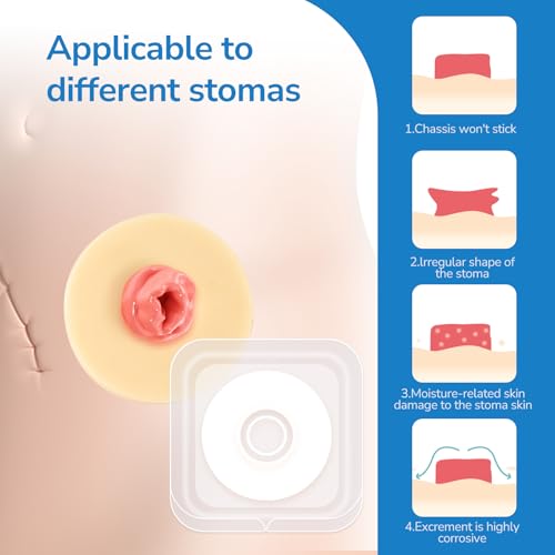 Ostomy Barrier Ring 10PCS Thick 4mm Moldable Hydrocolloid 48mm - Variation of THIS Listing