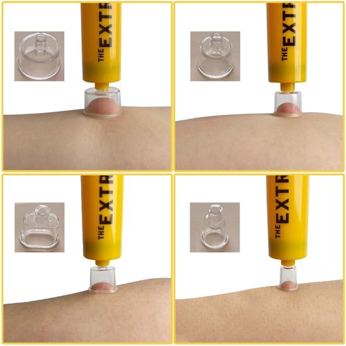 Snake Bite Kit for Humans, Bee Sting Kit, Venom Extractor Suction Pump Tool, Bite and Sting First Aid for Hiking, Safety Fast Emergency for Hiking Backpacking and Camping