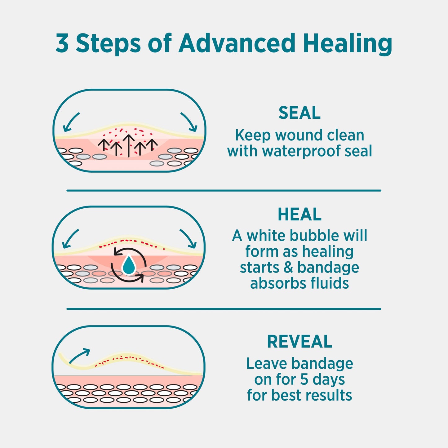 BAND-AID Brand Pro Heal 5 Day Protect, Ultra-Thin Hydrocolloid for Advanced Healing, 100% Waterproof First Aid Adhesive Bandages Provide Less Scarring Than Uncovered Wound, Assorted Sizes, 14 Count